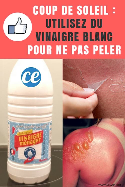 Sunburn:Use White Vinegar To Not Peel (And Avoid Blisters). 