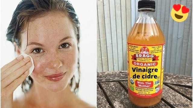 Acne, Eczema, Cold Sores... 4 Super Apple Cider Vinegar Remedies. 