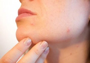 8 Tips to Avoid and Fight Acne. 