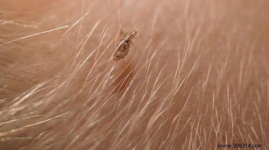 The 10 Best Natural Lice Remedies. 