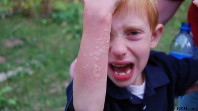 Stinging Nettles:The QUICK Remedy For Itching. 