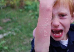 Stinging Nettles:The QUICK Remedy For Itching. 