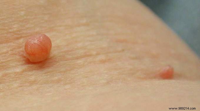 7 Fantastic Remedies To Get Rid Of Skin Tags. 