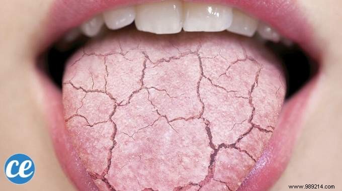 10 Simple And Effective Remedies For Dry Mouth. 