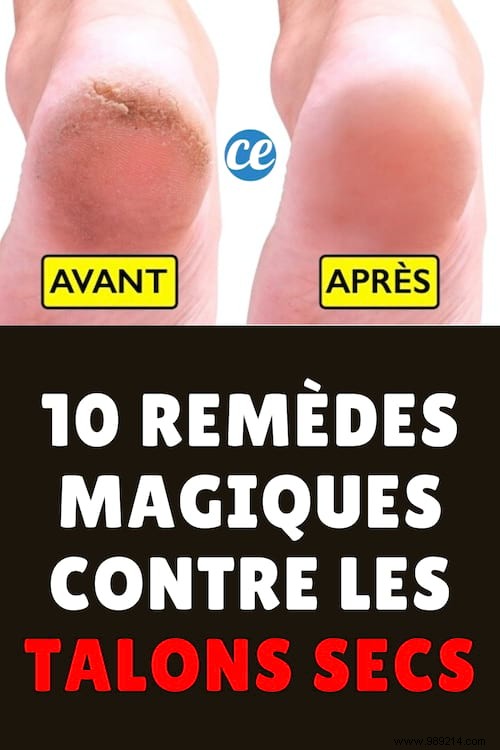 10 MIRACLE Remedies for Dry and Cracked Heels. 