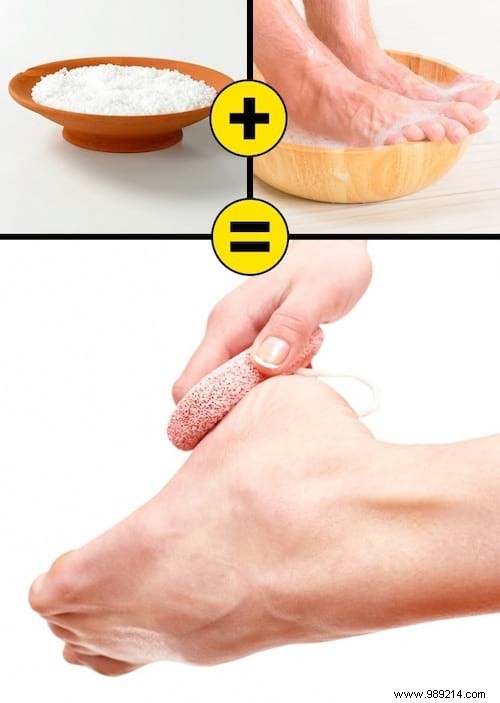 10 MIRACLE Remedies for Dry and Cracked Heels. 