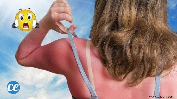 15 Natural Remedies To Relieve A Sunburn WITHOUT Biafine. 