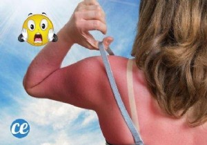 15 Natural Remedies To Relieve A Sunburn WITHOUT Biafine. 