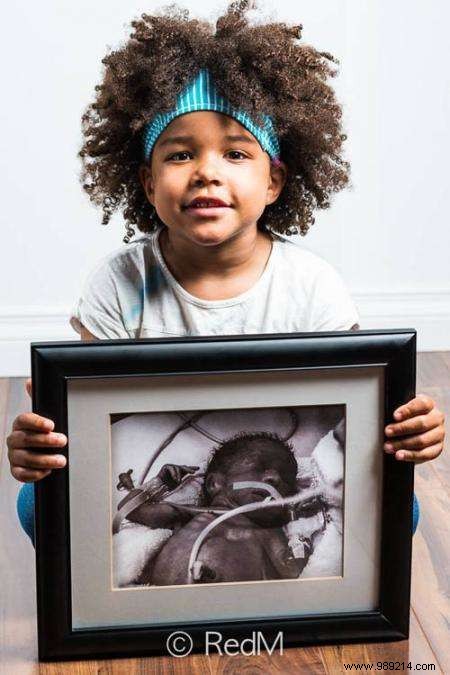 17 Photos of Premature Babies Who Hold Photo Two When They Were Babies. 