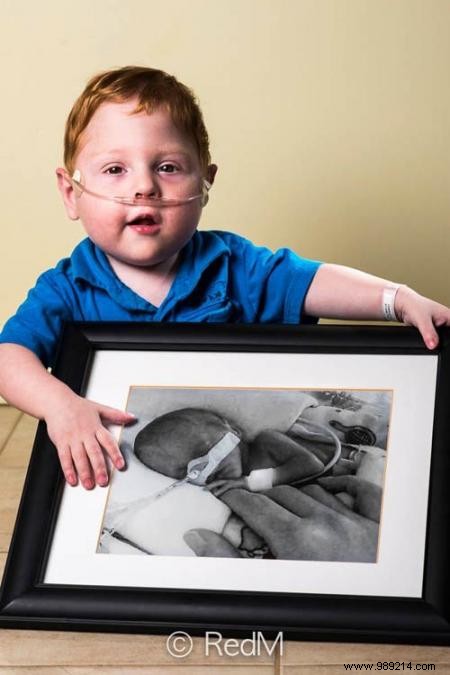 17 Photos of Premature Babies Who Hold Photo Two When They Were Babies. 