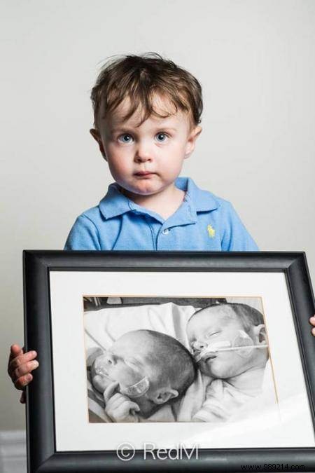 17 Photos of Premature Babies Who Hold Photo Two When They Were Babies. 