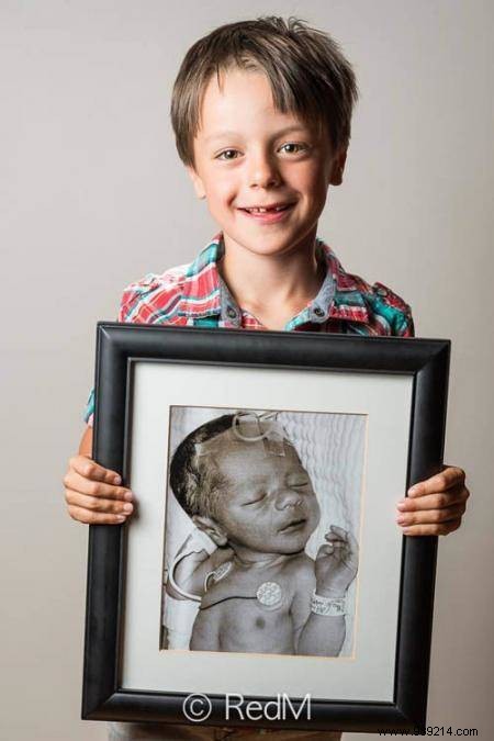 17 Photos of Premature Babies Who Hold Photo Two When They Were Babies. 