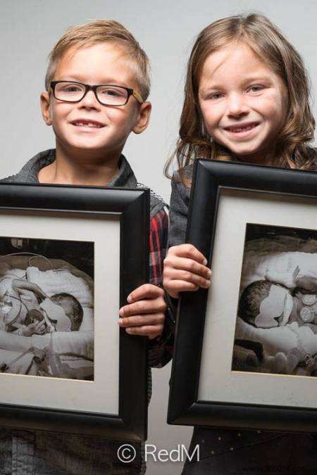 17 Photos of Premature Babies Who Hold Photo Two When They Were Babies. 