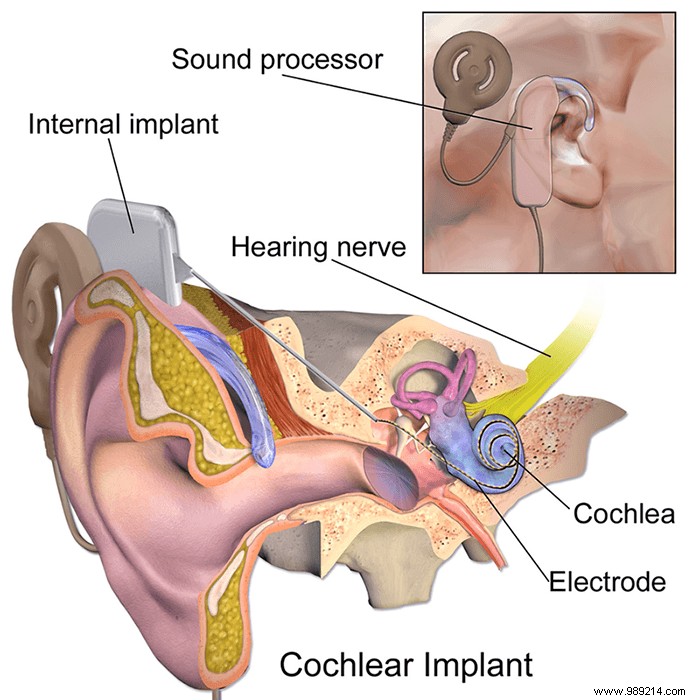 Brain-Computer Interfaces:What Are They and Why Do We Hear About Them Now? 