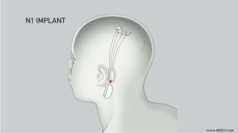 Brain-Computer Interfaces:What Are They and Why Do We Hear About Them Now? 