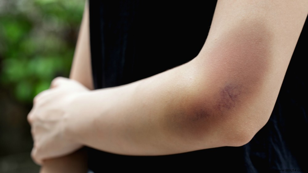 4 solutions against bruises 