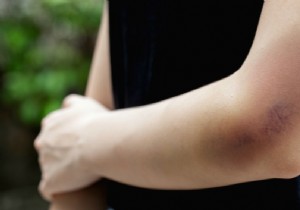 4 solutions against bruises 