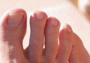 Treating an ingrown toenail:this is how you do it 