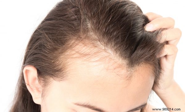 Hair loss remains a taboo 