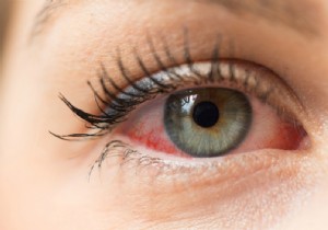 7 Possible Causes of Red Eyes 