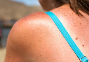 Burned by the sun? How to treat your skin 