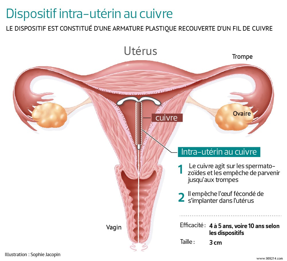 Hormonal IUD versus copper IUD:which one to choose? 