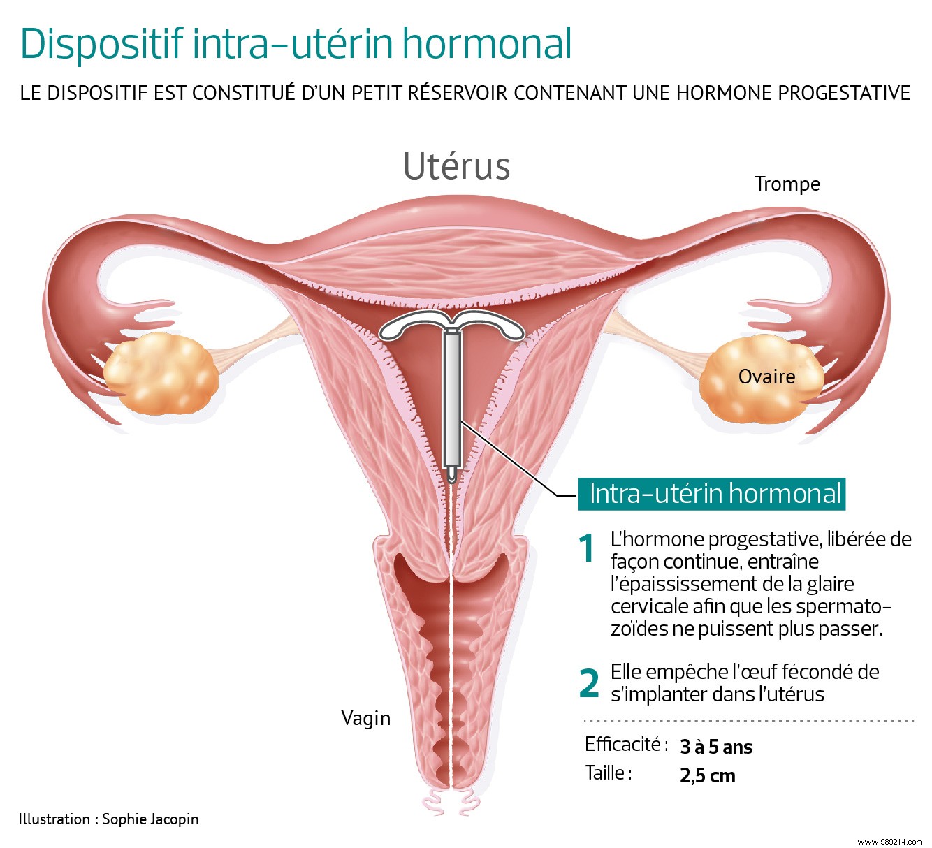 Hormonal IUD versus copper IUD:which one to choose? 