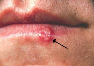 The cold sore:what is it, how to treat it? 