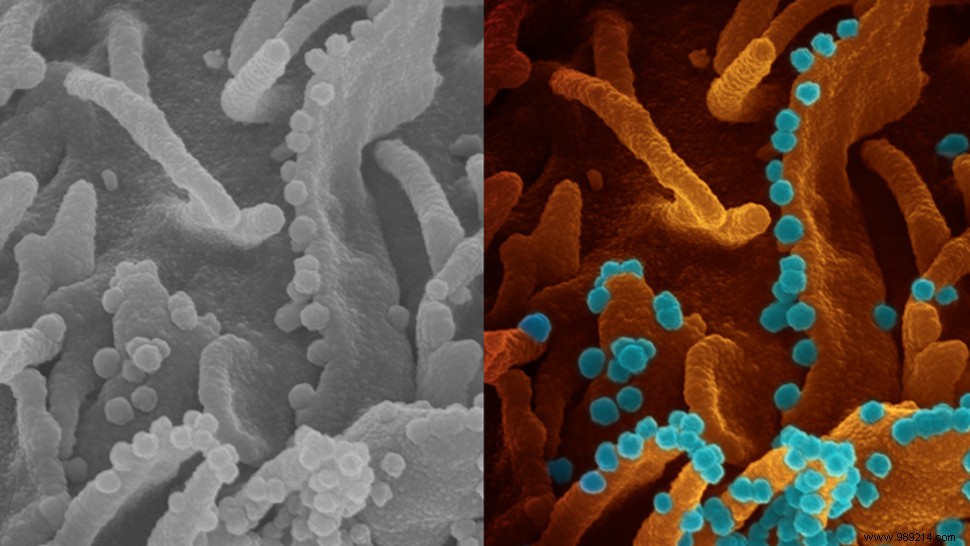 SARS-CoV-2:This is what a  viral shedding  looks like under a microscope 