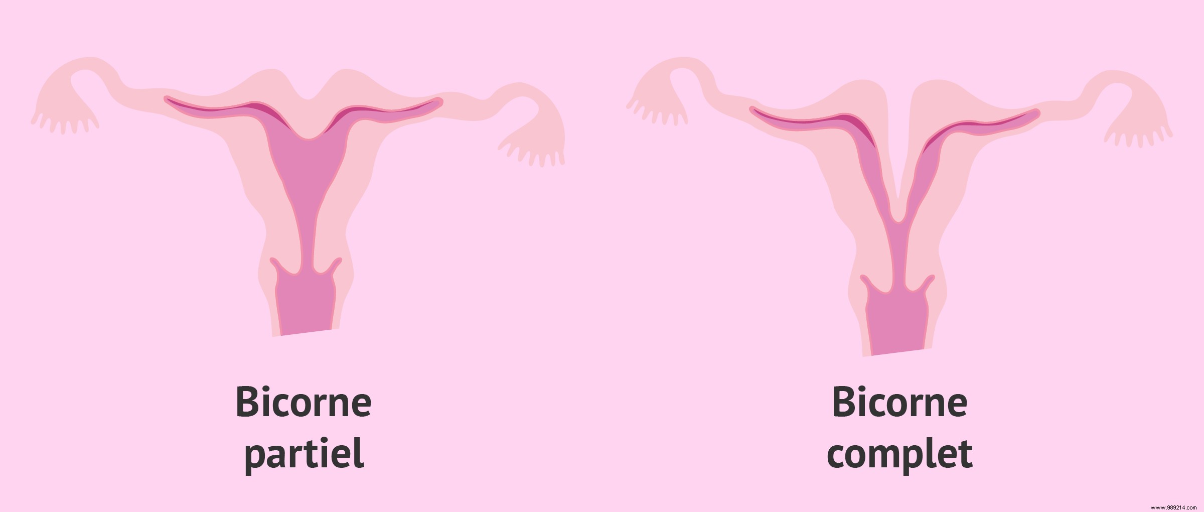 A patient is pregnant with four children in two different wombs! 