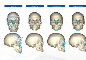 They perform a double hand and face transplant using 3D printing 