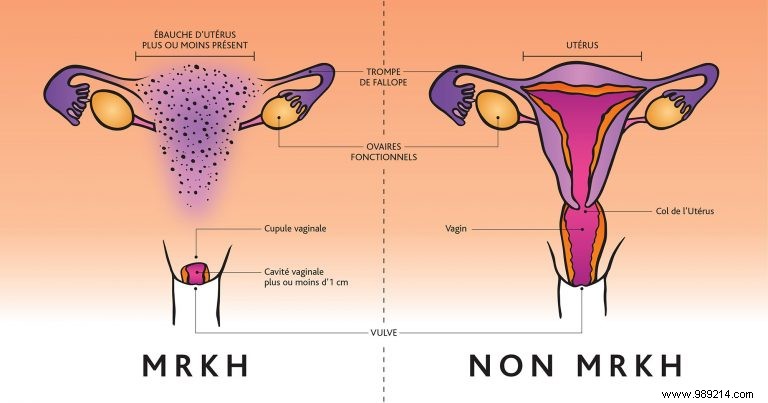 Rokitansky syndrome:these women born without a uterus and without a vagina 