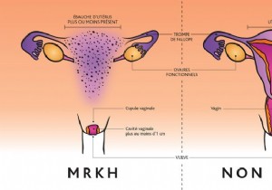 Rokitansky syndrome:these women born without a uterus and without a vagina 