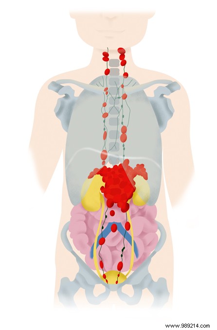 Childhood cancer:a new strategic discovery 