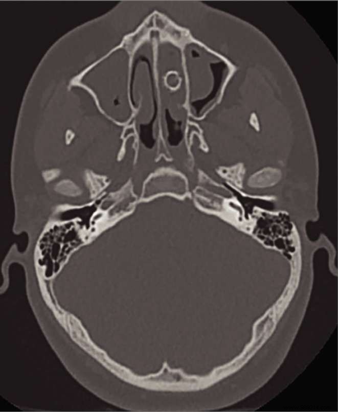 This patient gave off a strong odor every time he blew his nose! 