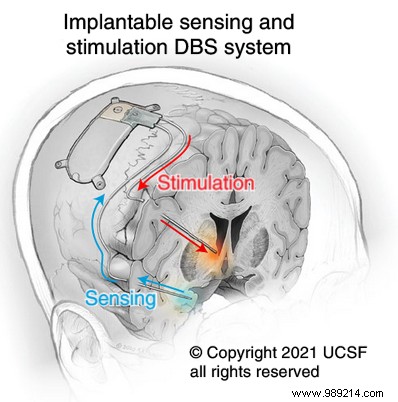 Victim of depression, this woman was treated via an electrical brain implant 