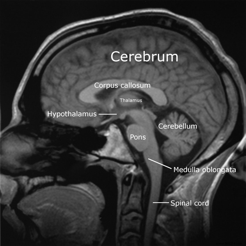 Too much salt in the brain causes slow blood flow 