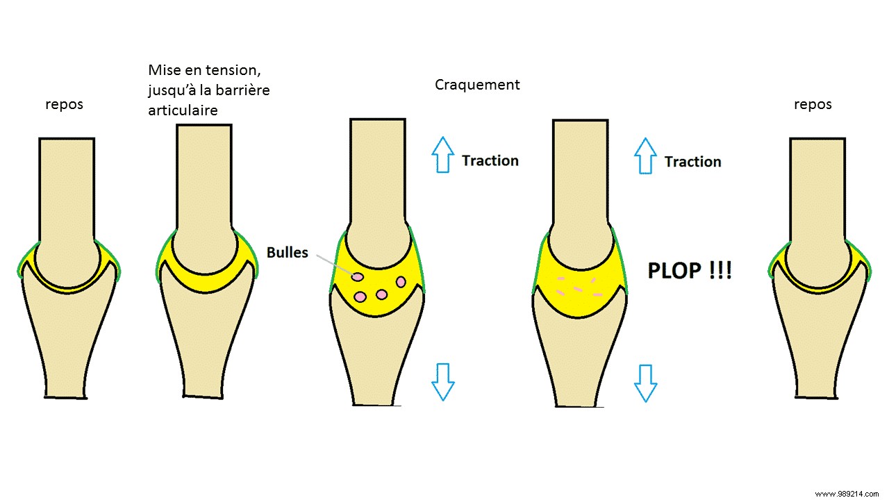 Cracking your joints:what are the risks of this mania? 