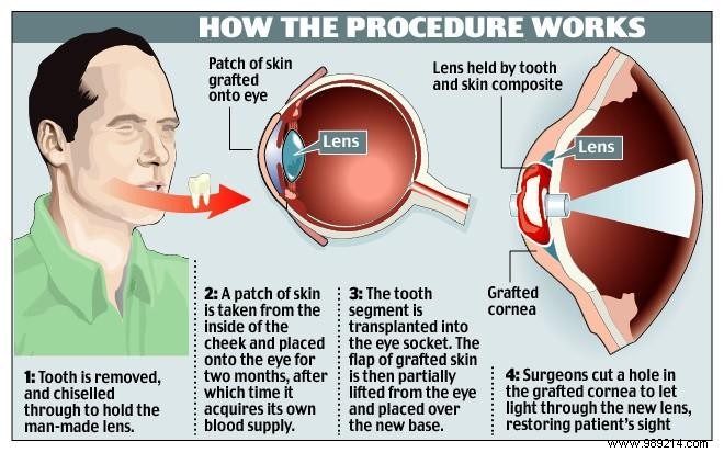 It is possible to regain sight thanks to an ocular implant made from a tooth 