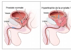 A major discovery for the treatment of prostate cancer 